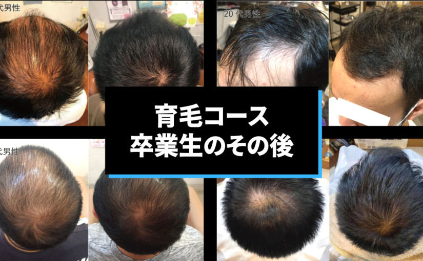 育毛卒業生のその後